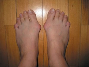 Лечение косточек на большом пальце ноги - как избавиться от косточки на ноге - Блог manikyrsha.ru